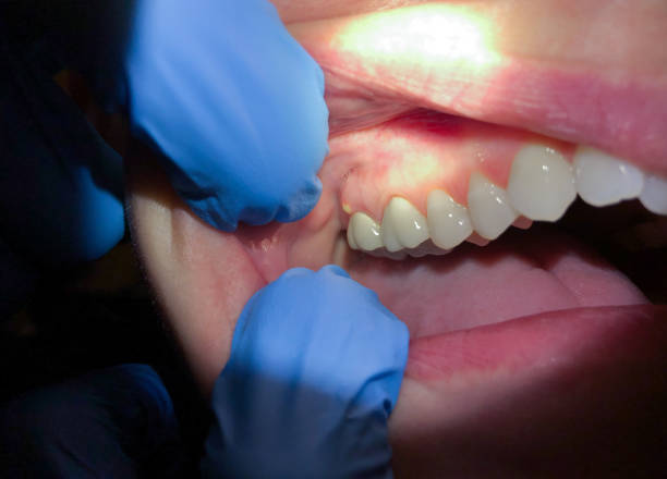 Best Emergency Treatment for Oral Infections in Midland City, AL